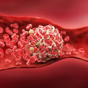 Illustrasjon: blodpropp i en arterie