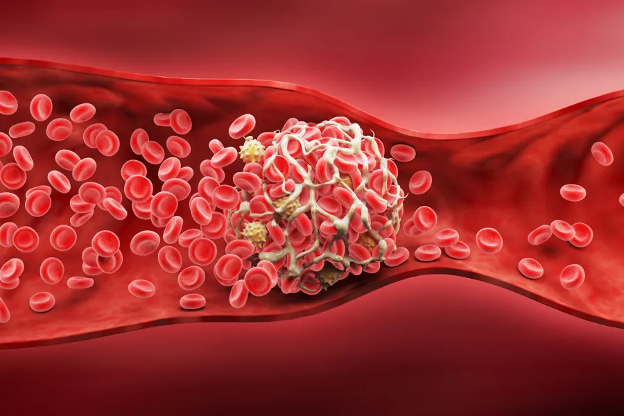 Illustrasjon: blodpropp i en arterie