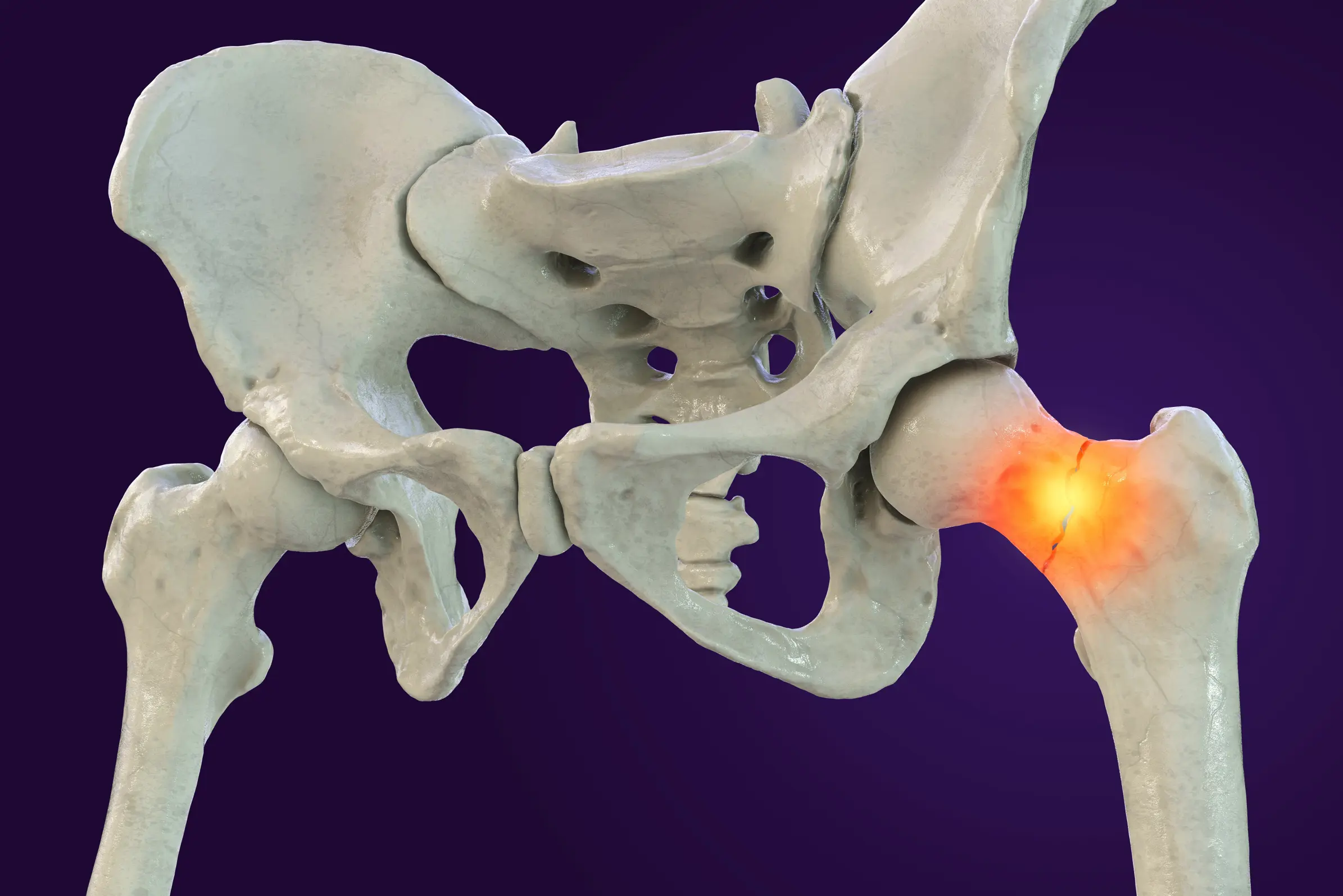 Illustrasjon av hoftebrudd